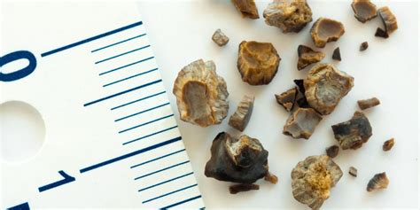 Different Types Of Kidney Stones Advanced Urology Medical Offices