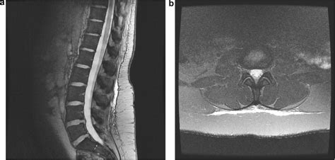 Subcutaneous Fluid Collection Following Single Shot Spinal Anaesthesia