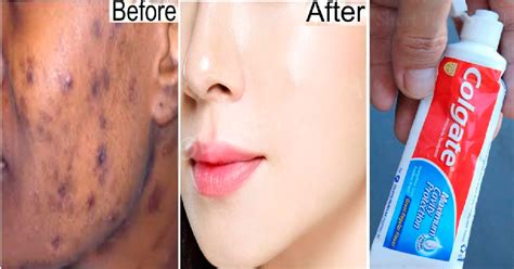 Home Remedies To Remove Dark Spots And Pimples From Face How To