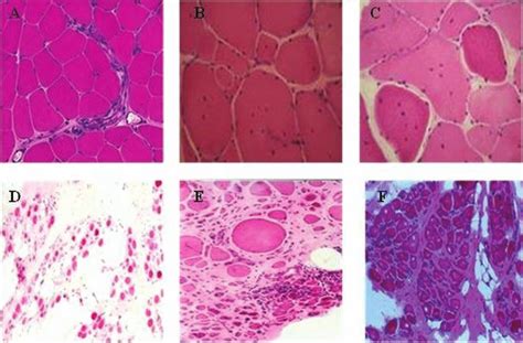 Distrofias musculares hallazgos histopatológicos A músculo normal