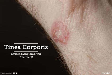 Tinea Corporis Causes Symptoms And Treatment By Sakhiya Skin