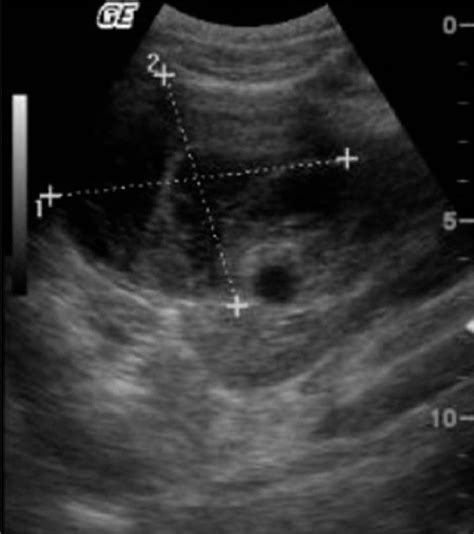 Abdominal Cyst Fetal Ultrasound