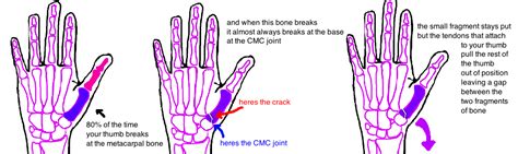 Broken Thumb First Metacarpal Fracture — Bone Talks