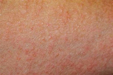 Anxiety Rash Causes Symptoms And Treatment Options