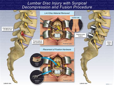 Lumbar Disc Injury With Surgical Decompression And Fusion Procedure