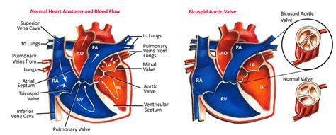 Bicuspid Aortic Valve Causes Symptoms Treatment Bicuspid Aortic Valve