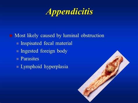 Acute Appendicitis In Children Nurse Info