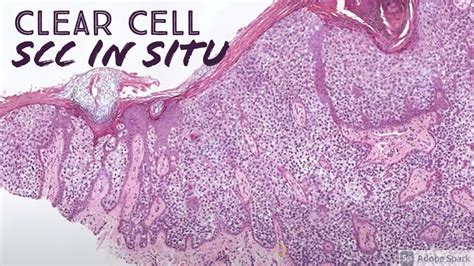 Clear Cell Squamous Cell Carcinoma In Situ Bowen Disease With