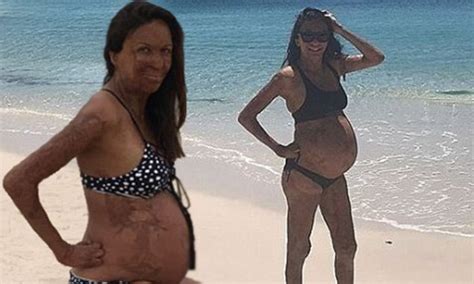 Turia Pitt Shows Off Her Baby Bump On Instagram Daily Mail Online