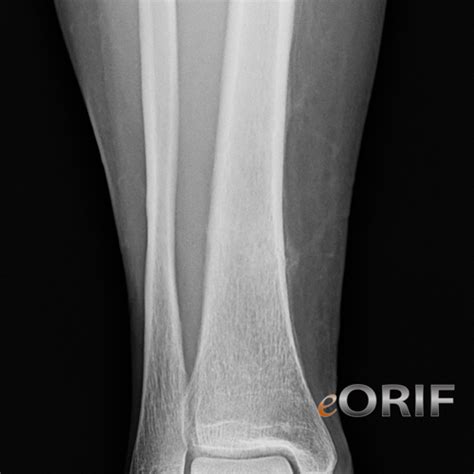 Tibial Shaft Stress Fracture Images Eorif