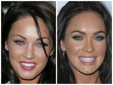 Celebrities With Veneers Before And After Before And After