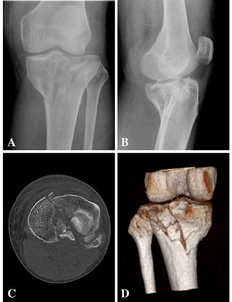 Schatzker classification of tibial plateau fractures. A Schatzker type IV tibial plateau fracture based on ...