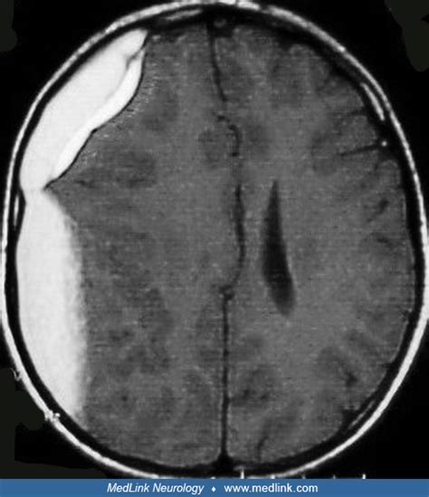 Chronic Subdural Hematoma Mri