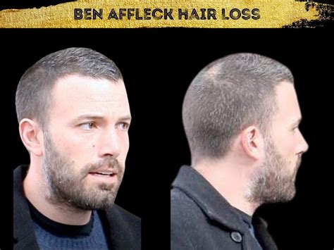 Ben Affleck Hair Transplant Hair Loss Technical Analysis