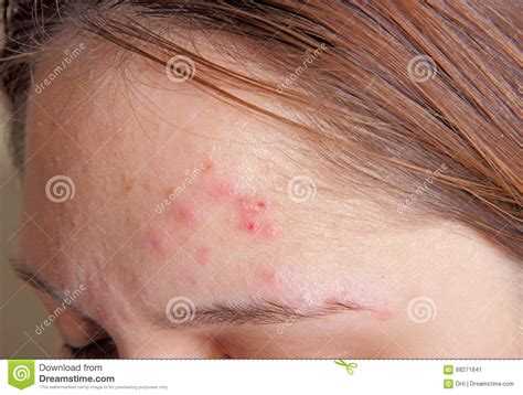 Acne On The Girl S Forehead Stock Image Image Of Girls Female 68271841