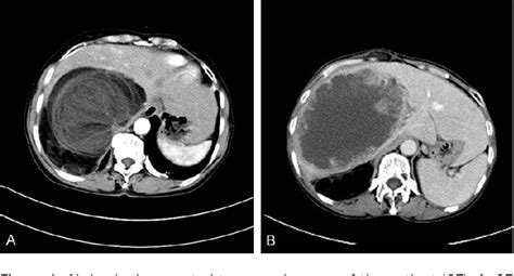 Figure 1 From Giant Recurrent Mixed Type Liposarcoma Of The