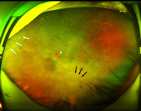 Ultra Widefield Fundus Photography Of The Left Eye 4 Months Following