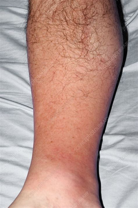 Cellulitis Of The Leg Stock Image C004 4223 Science Photo Library