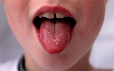 Strep A What Is It What Are The Symptoms And How Infectious Is It