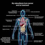 Side Effects From Lung Cancer Photos