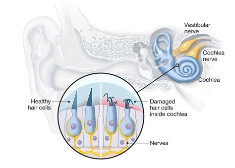 Why You Might Believe You Have Tinnitus After A Concert Sutton Hearing