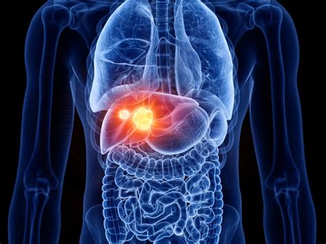 Liver Cancer Causes Symptoms Diagnosis Treatment Theranostics