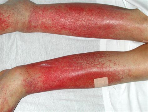Red Spots On Legs Causes Small Raised Flat Or Itchy Skincarederm
