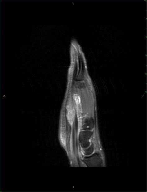 Giant Cell Tumor Of The Tendon Sheath Hand Musculoskeletal Case