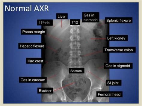 Presentation1 Interpretation Of X Ray Of The Abdomen