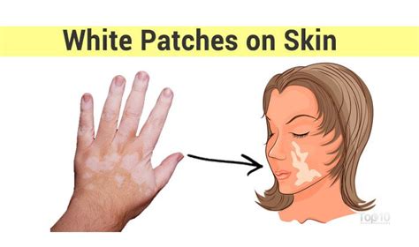 Zinc, calcium and vitamin b12 deficiency. How to Get Rid of White Patches on Skin, Vitiligo | Top 10 ...