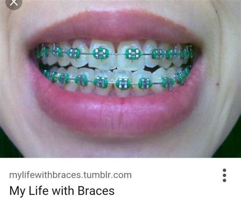 Green Braces Braces Colors Cute Braces Dental Braces Colors