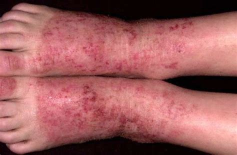 Dermatite Atópica Tratamentos Fotos Pomada Remédios E Sintomas