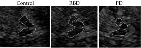 Typical Examples Of Transcranial Ultrasound Images Of The Midbrain