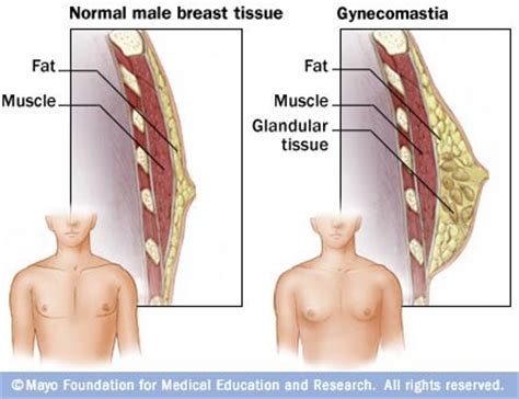 Gynecomastia Symptoms Risk Factors Treatment And Prognosis
