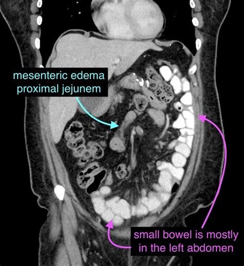 Internal Hernia Radiology Reference Article