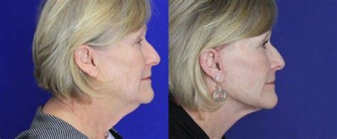 62 Year Old Lady Face And Neck Lift Under Local By Dr Desvigne