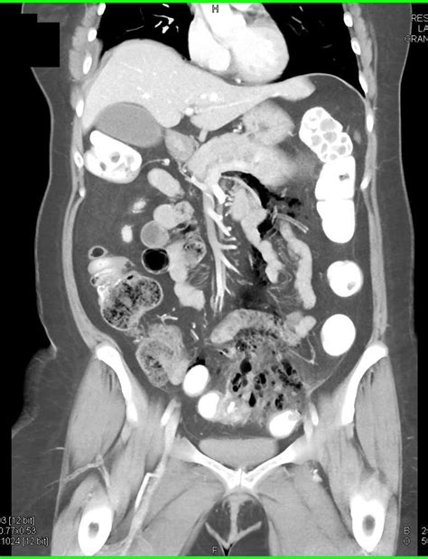 Diverticulitis With Abscess And Inflammation In Sigmoid Colon Colon