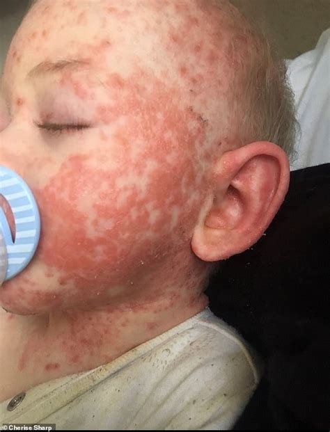 Mother Reveals Son 2 Had Such Severe Facial Eczema Strangers Mistook