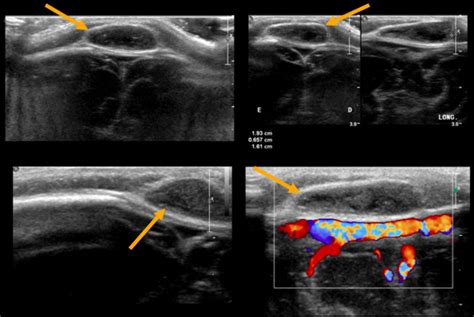 Sonographic Findings A Well Delimited Subcutaneous Nodule With Solid