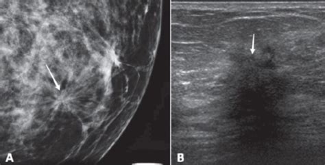 Mammography A In A 65 Year Old Woman Shows Architectu Open I