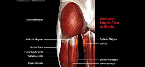 Torn Adductor Muscle