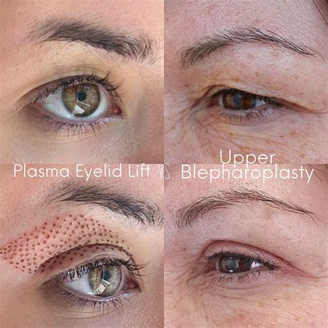 Plasma Lift Skin Tightening — Proud Brow