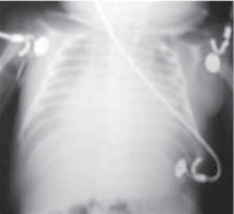 Radiograf A De T Rax De Paciente Intubado En Ventilaci N Mec Nica No Download Scientific