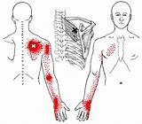 Pictures of Trigger Point Therapy Shoulder