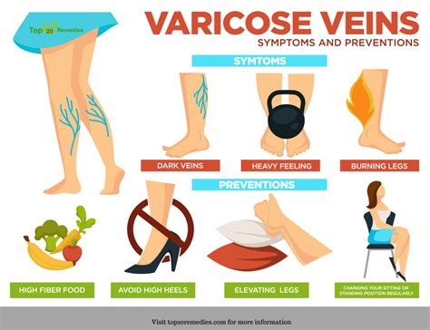 What Are Some Good Home Remedies For Varicose Veins Top 20 Remedies