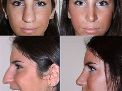 Jen Selters Before And After Nose Job Photos Show How Her Appearance