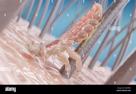 3d Rendered Illustration Of A Head Louse On A Human Head Stock Photo