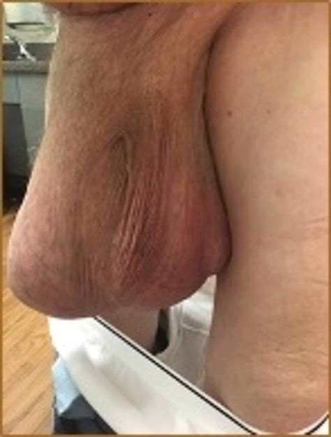 Cureus Repair Of A Giant Inguinal Hernia Hot Sex Picture