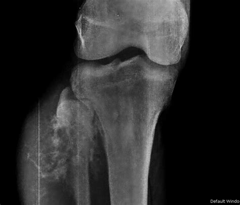 Fibular Osteosarcoma Imaging Sumers Radiology Blog