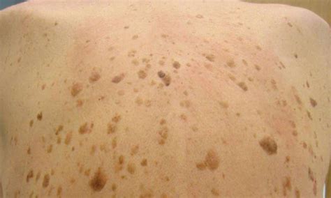 Study Points To The First Topical Treatment For Common Benign Skin Lesions